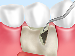 進行した歯周病の治療「フラップ手術」