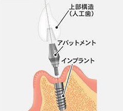 骨が足りずインプラント治療はできないと言われてしまった方へ