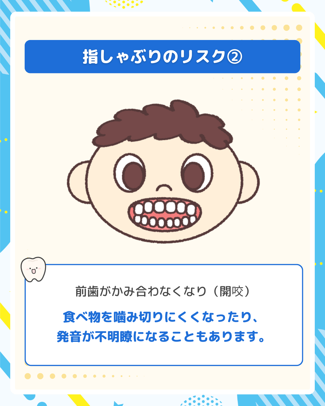 指しゃぶりによる開咬（前歯が噛み合わない状態）のイラスト