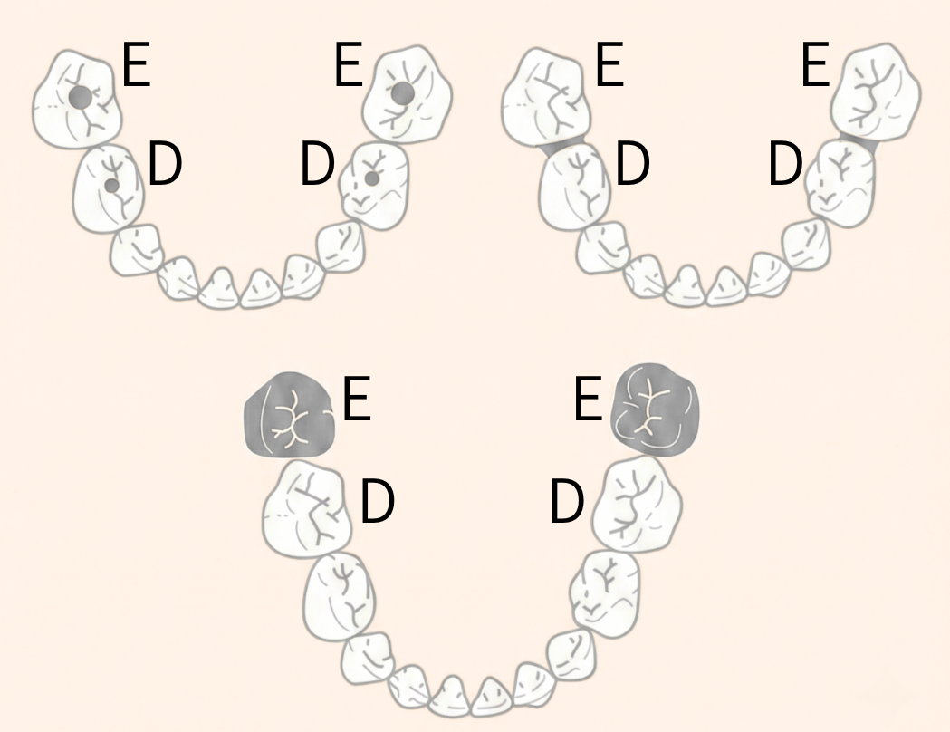 2歳半-6歳の虫歯好発部位（DE間）のイラスト図