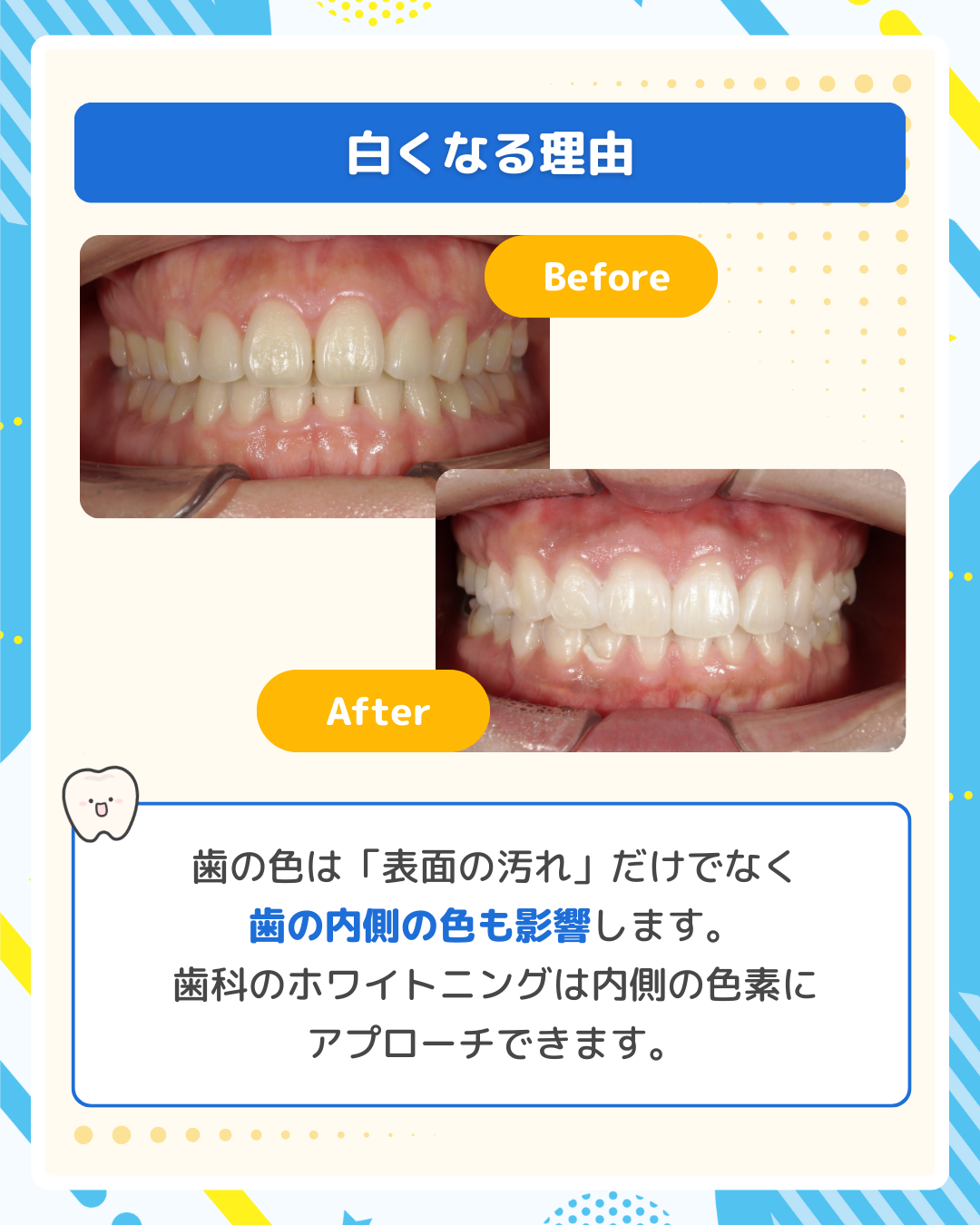 ホワイトニングのBefore/After写真